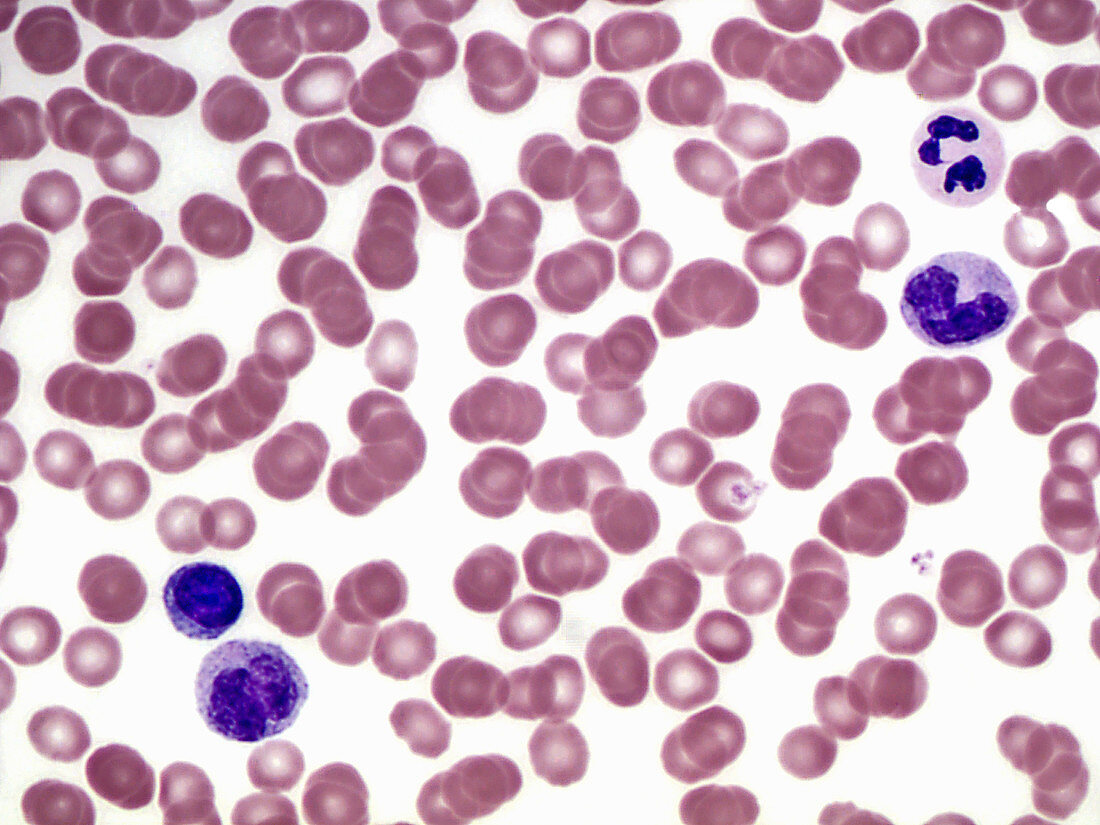 Peripheral blood smear, LM