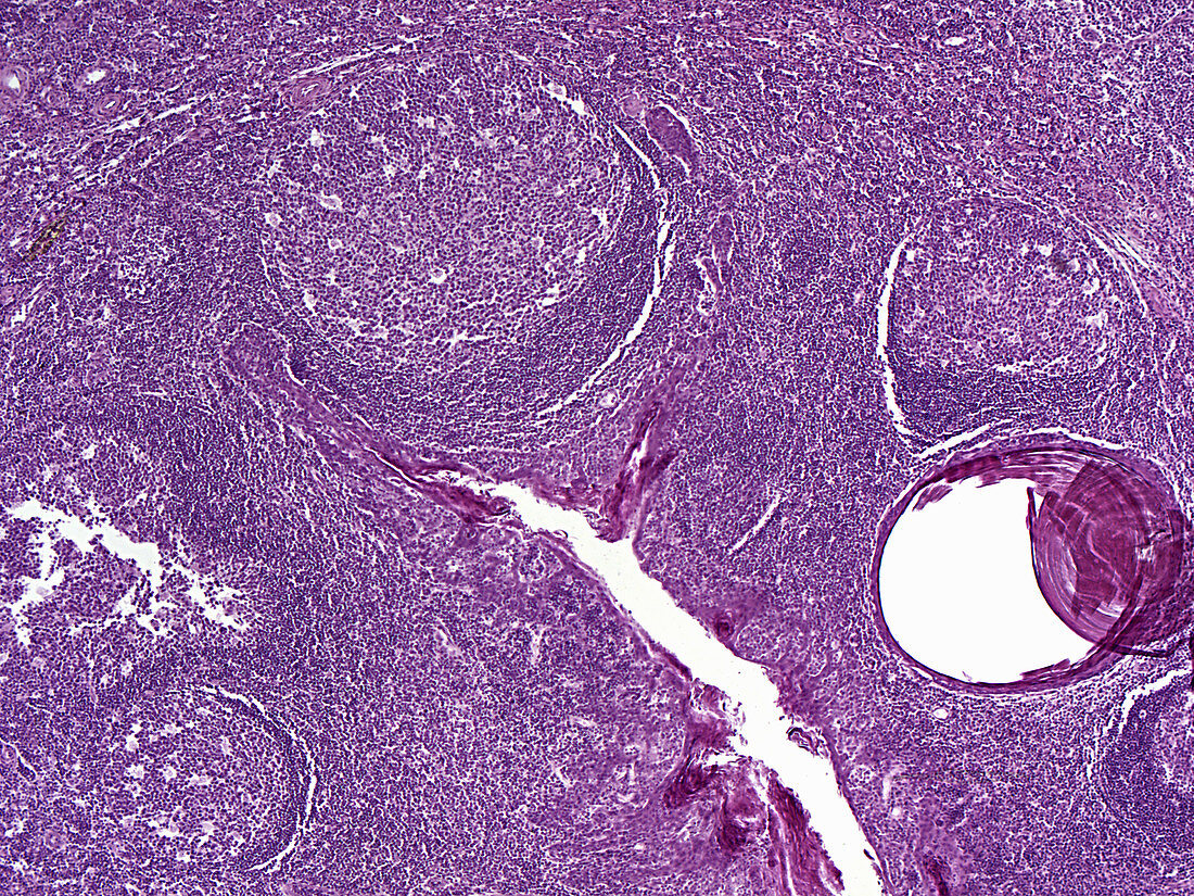 Palatine tonsil, human, LM