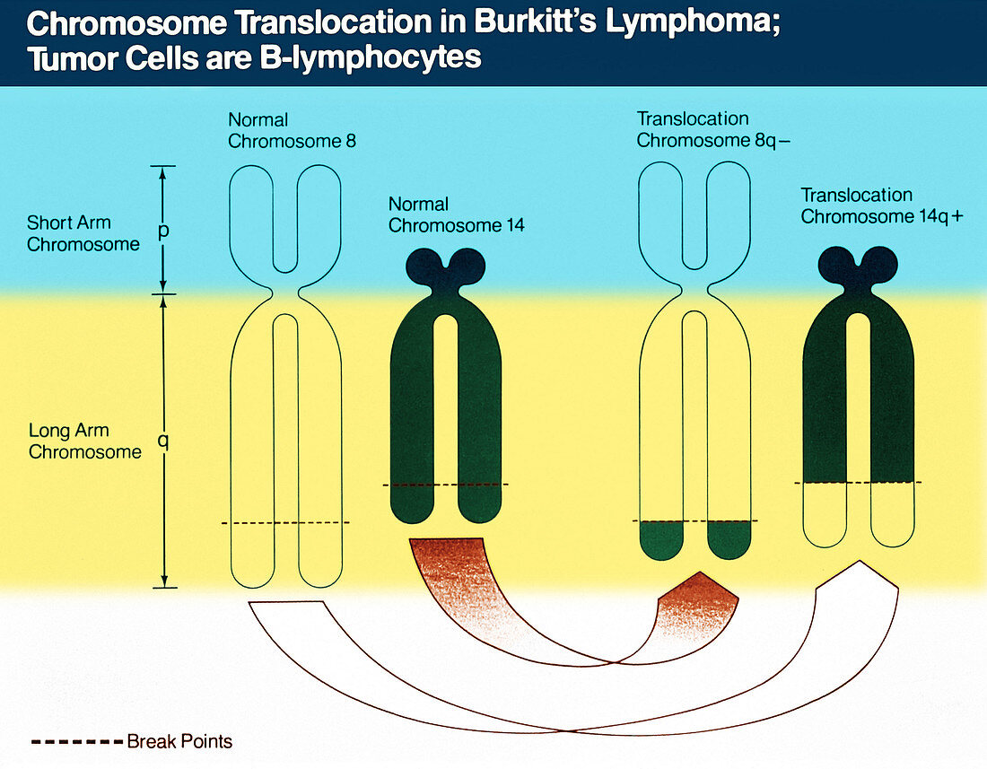 Burkitt's Lymphoma, Chromosome Diagram