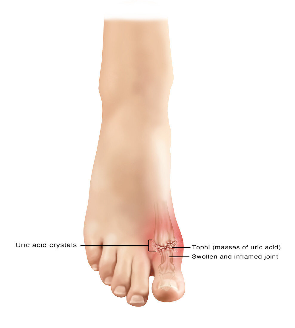Gout in Foot, Illustration