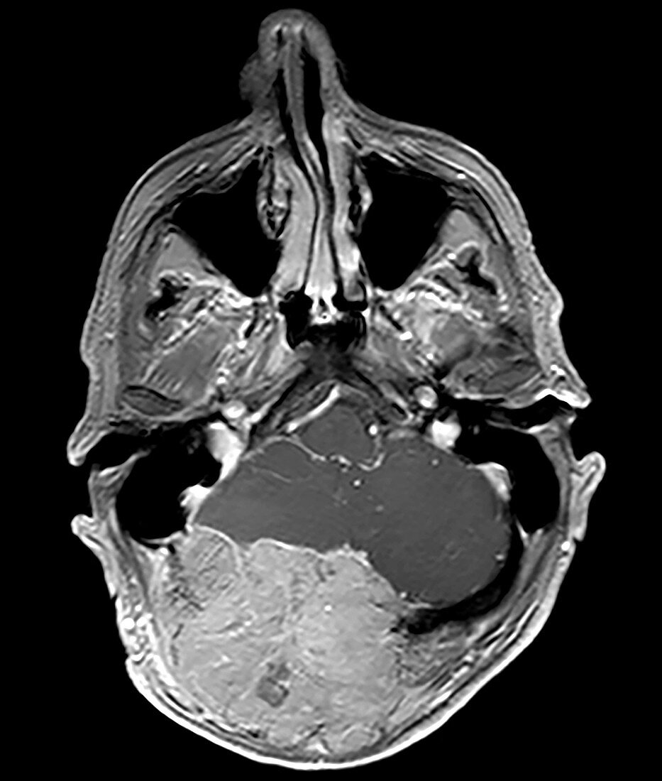 Metastatic Renal Carcinoma to Skull and Brain, MRI