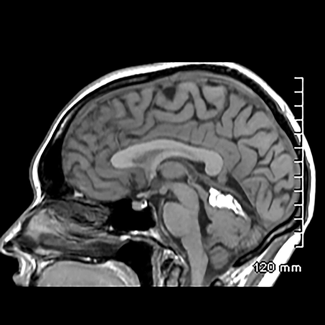 Lipoma of Supracerebellar Cistern, MRI
