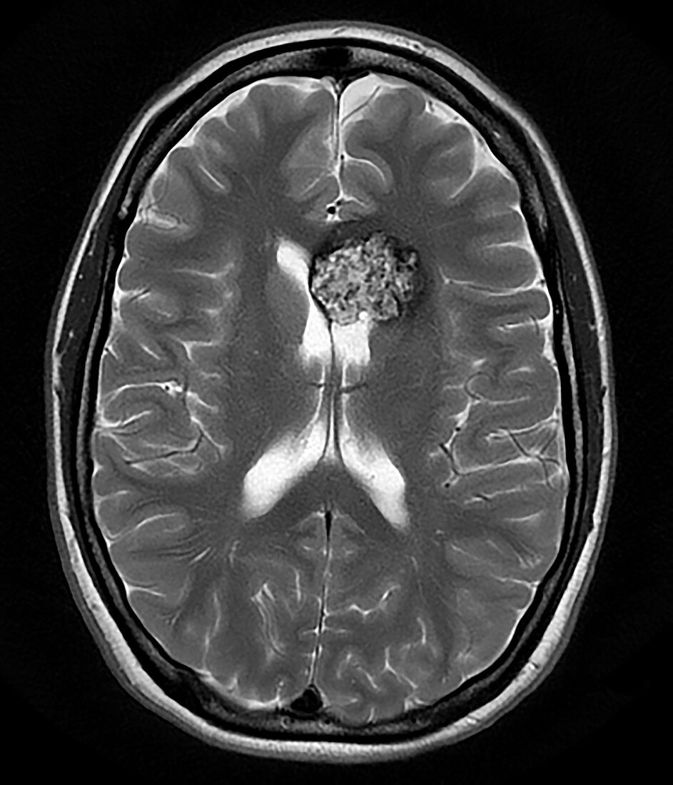 Cavernous Malformation of Brain, MRI