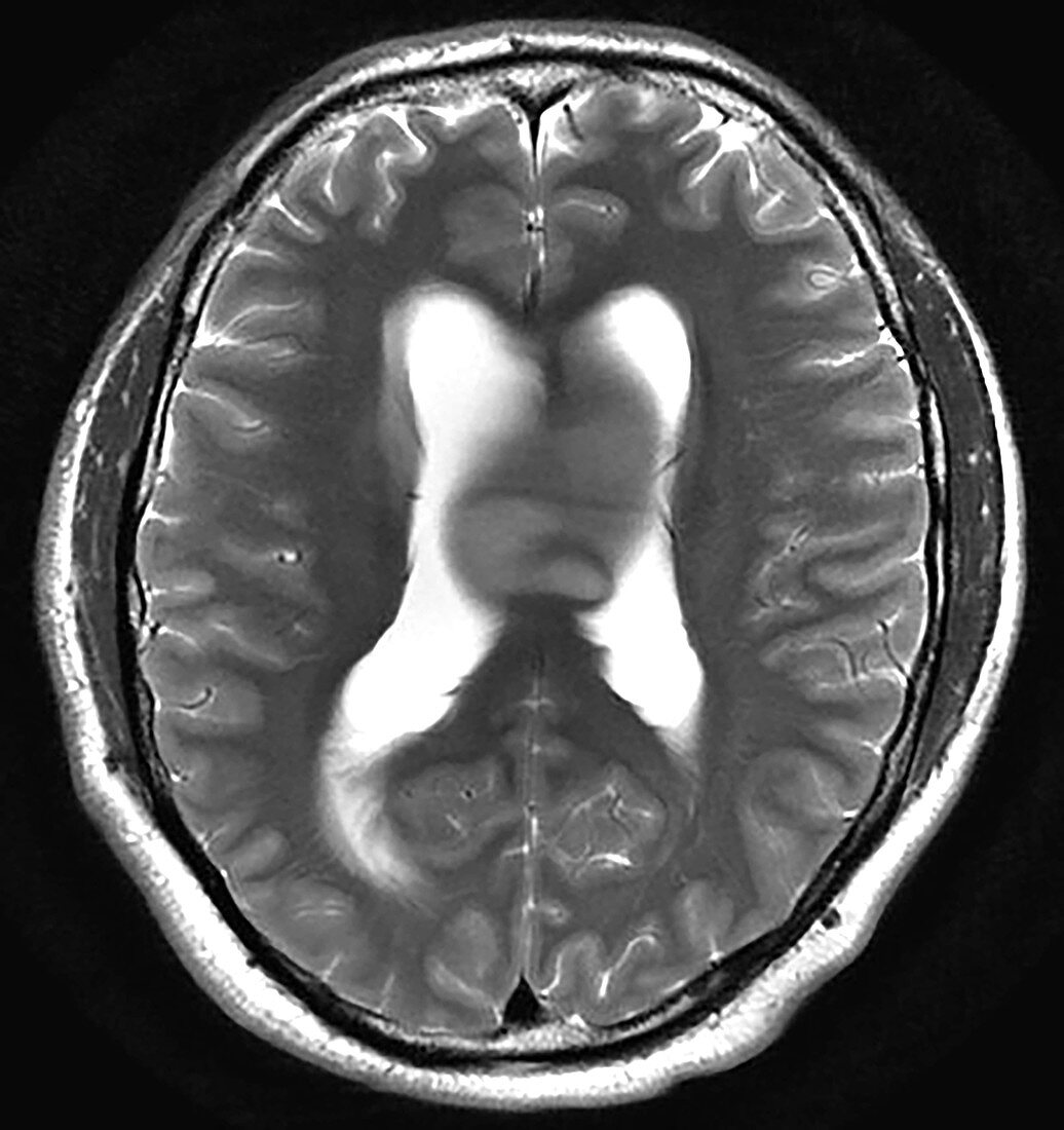 Anaplastic Astrocytoma, MRI