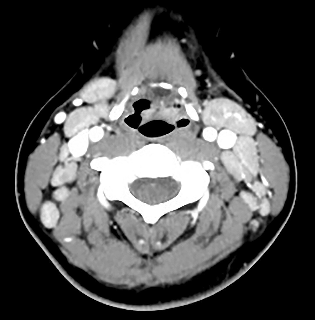 Enlarged Lymph Nodes, Infectious Mononucleosis, CT