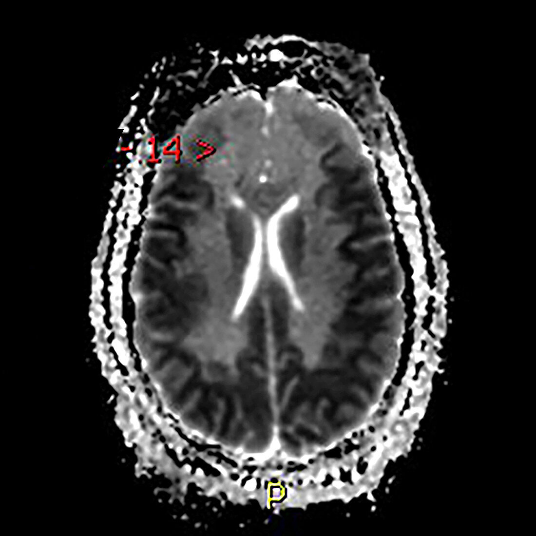 Diffuse Anoxic Injury after Cardiac Arrest, MRI
