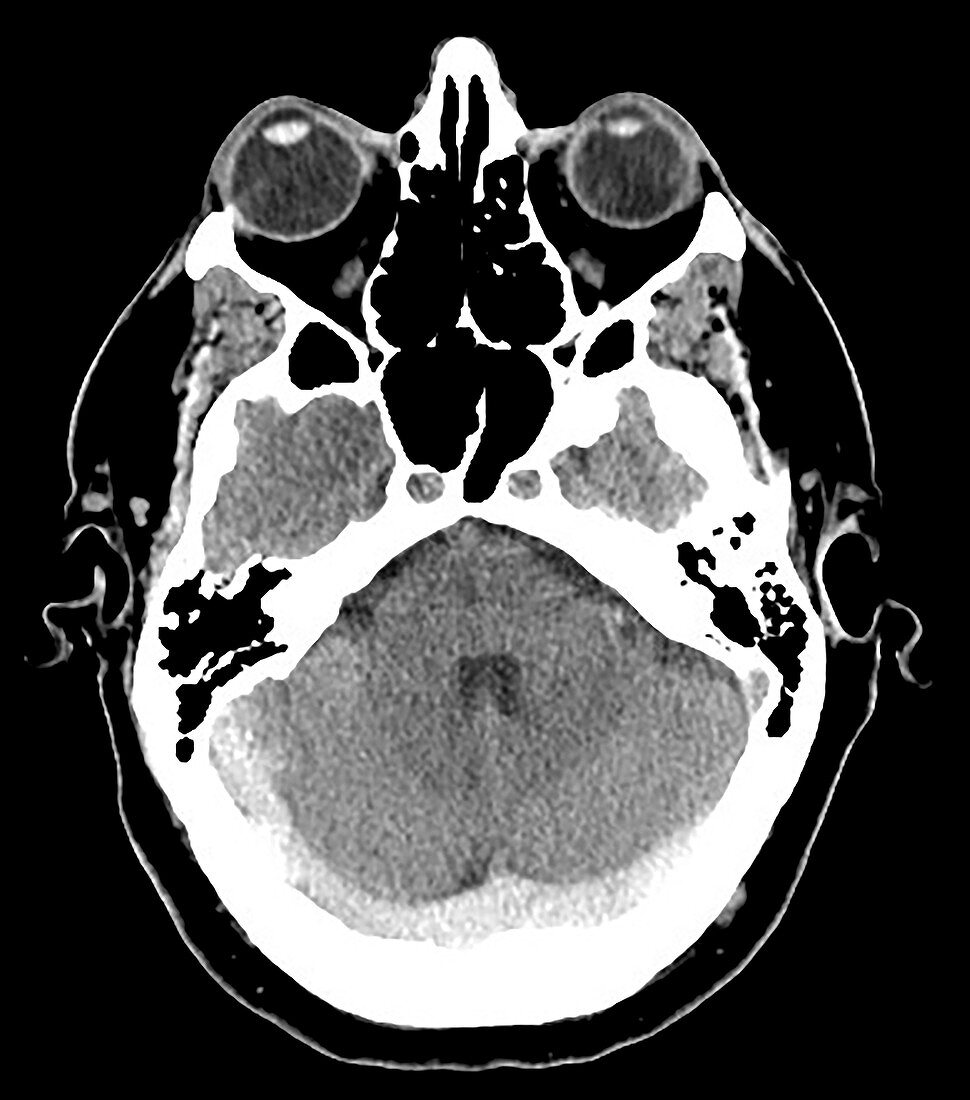 Extensive Dural Sinus Thrombosis, CT