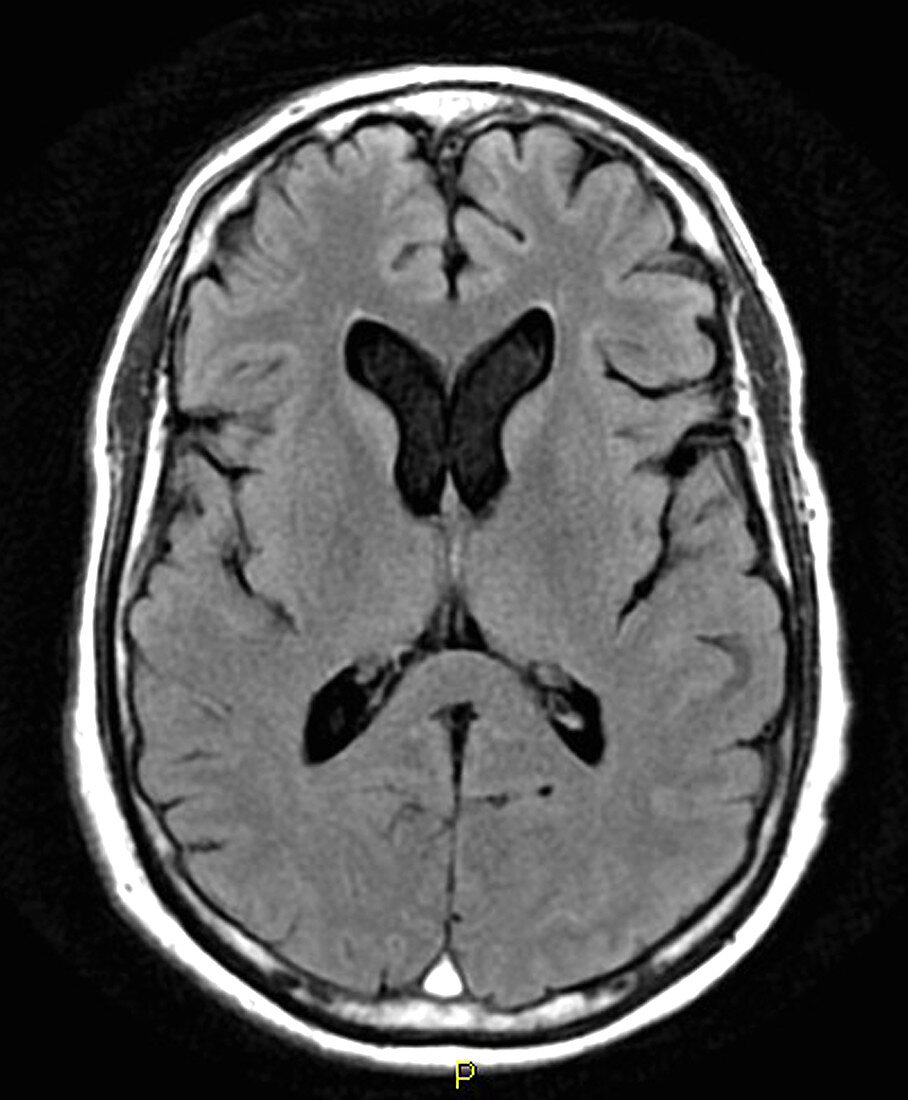 Extensive Dural Sinus Thrombosis, MRI