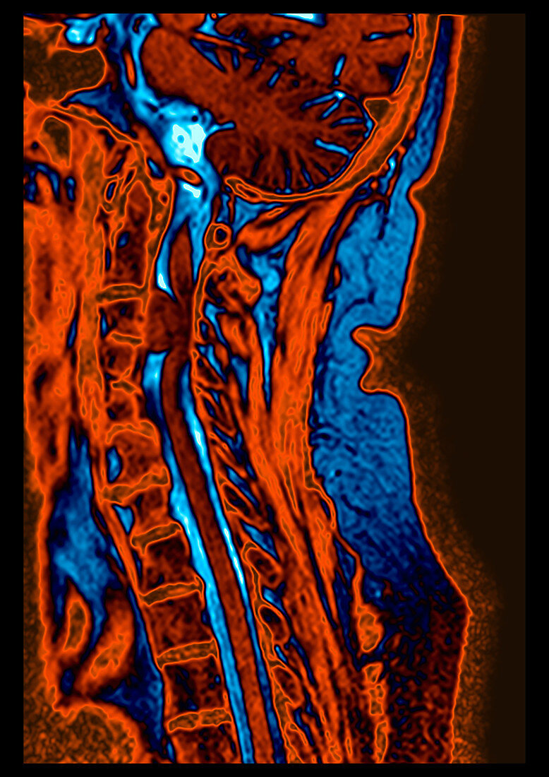 Cervical Spine Meningioma, MRI