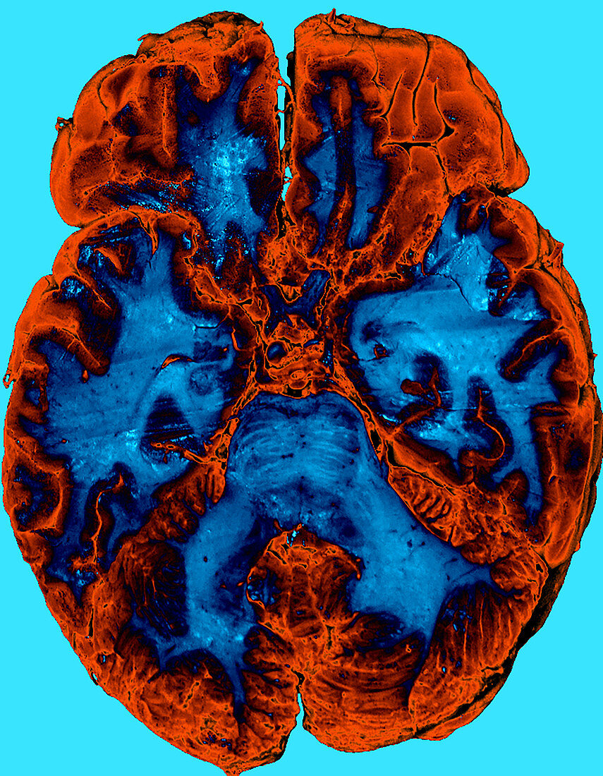 Enhanced Cadaver Brain Section