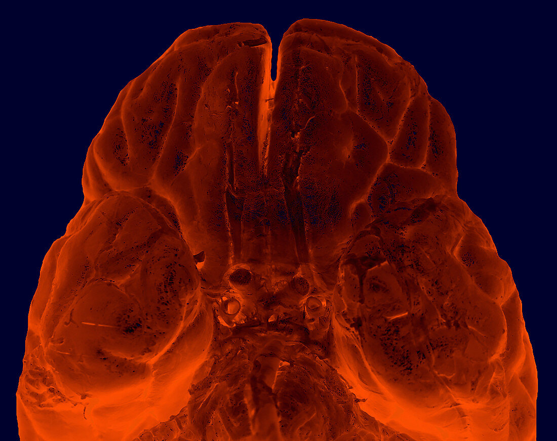 Inferior View of Brain