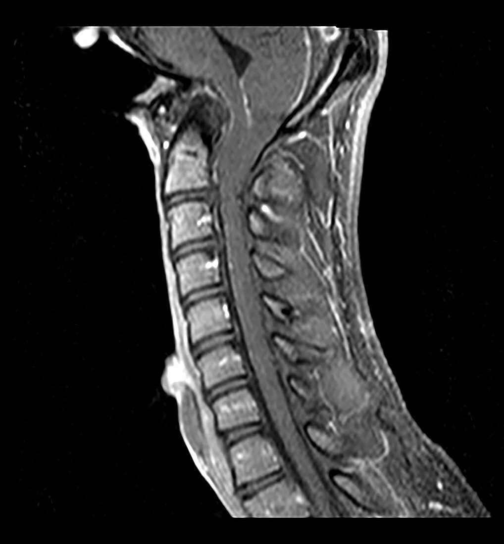 Congenital Assimilation of C1 to Skull Base, MRI