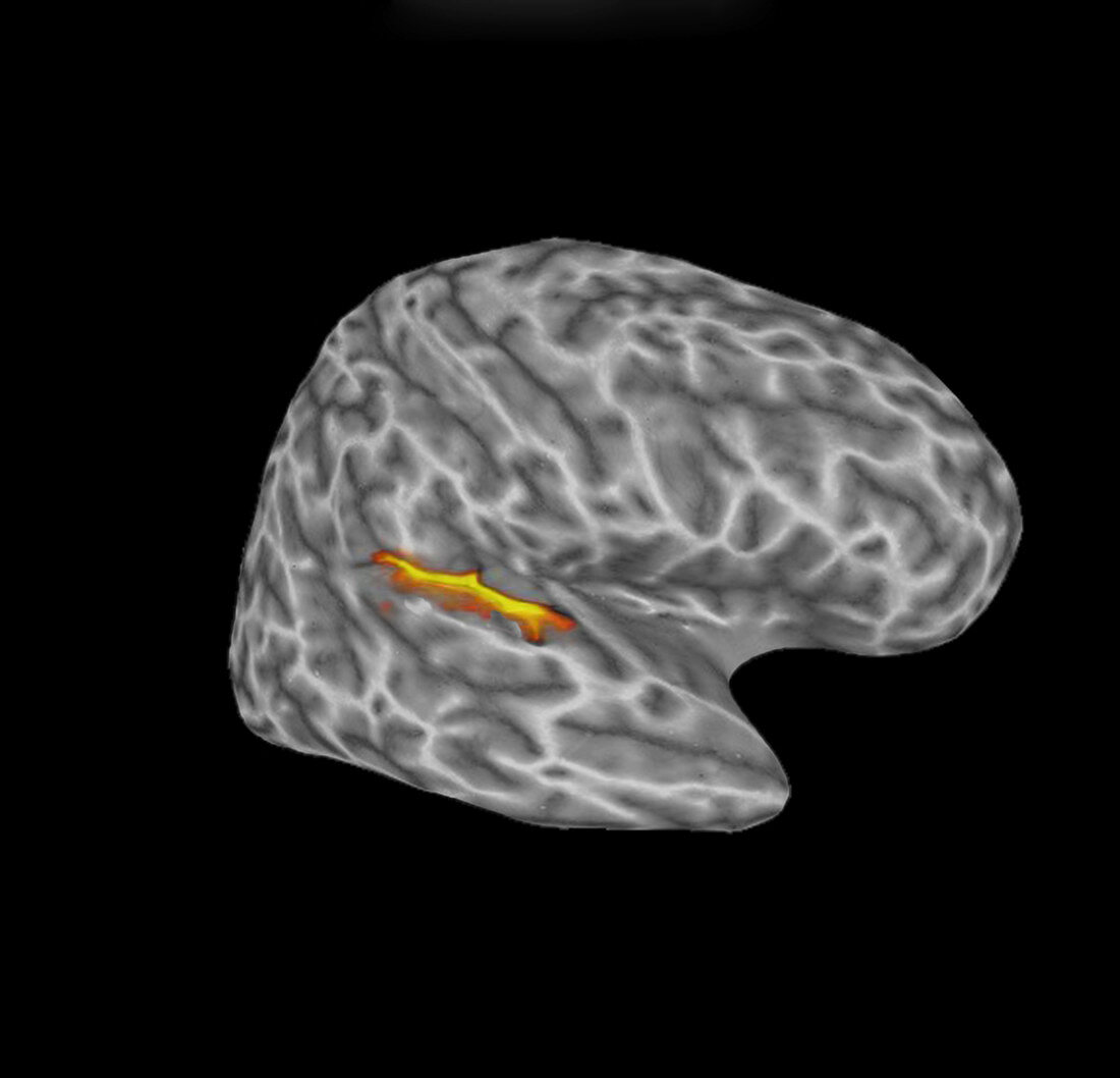 Functional MRI, auditory stimulus