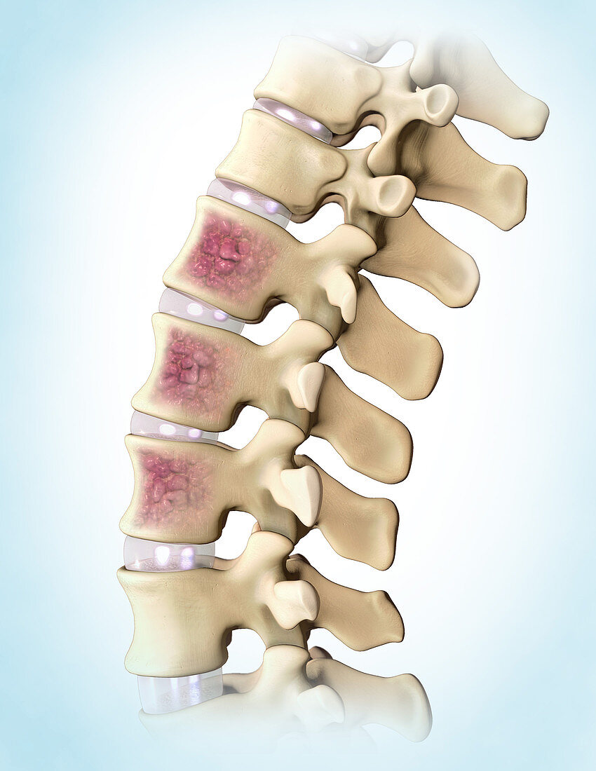 Multiple Myeloma, Spine