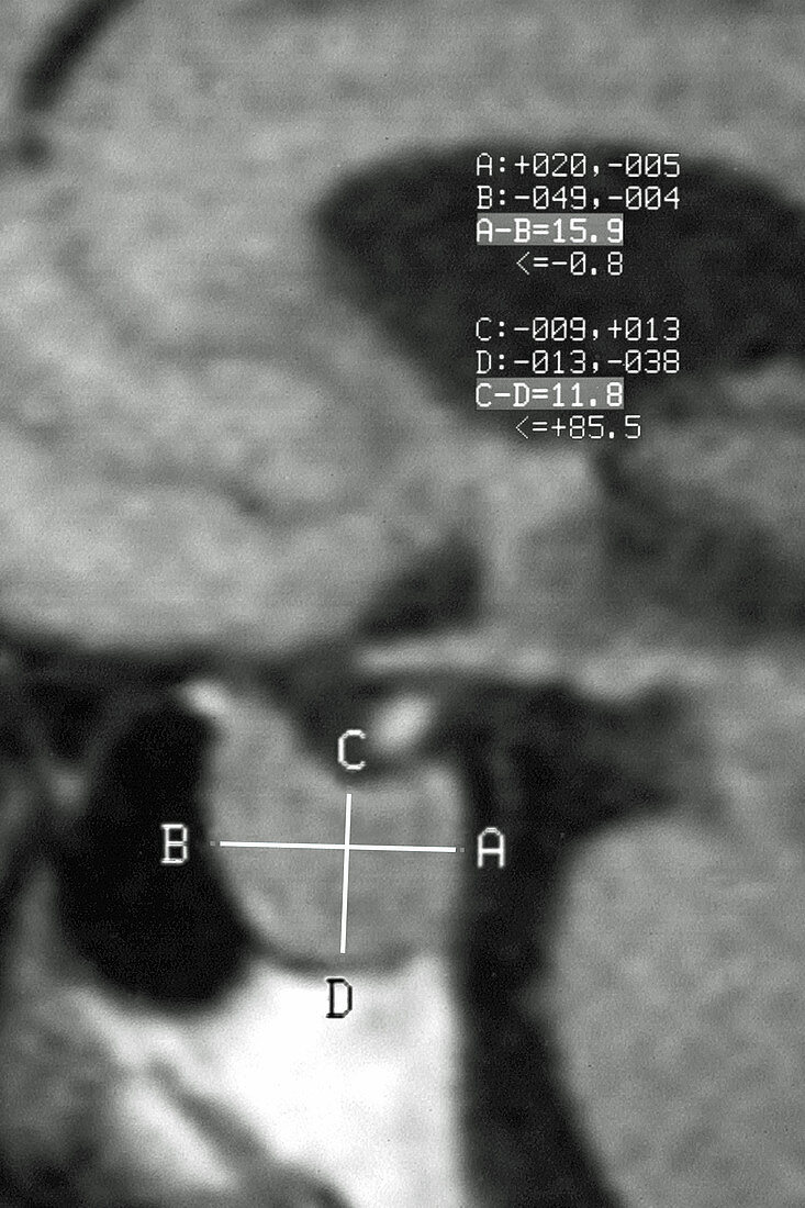 Pituitary Adenoma, MRI
