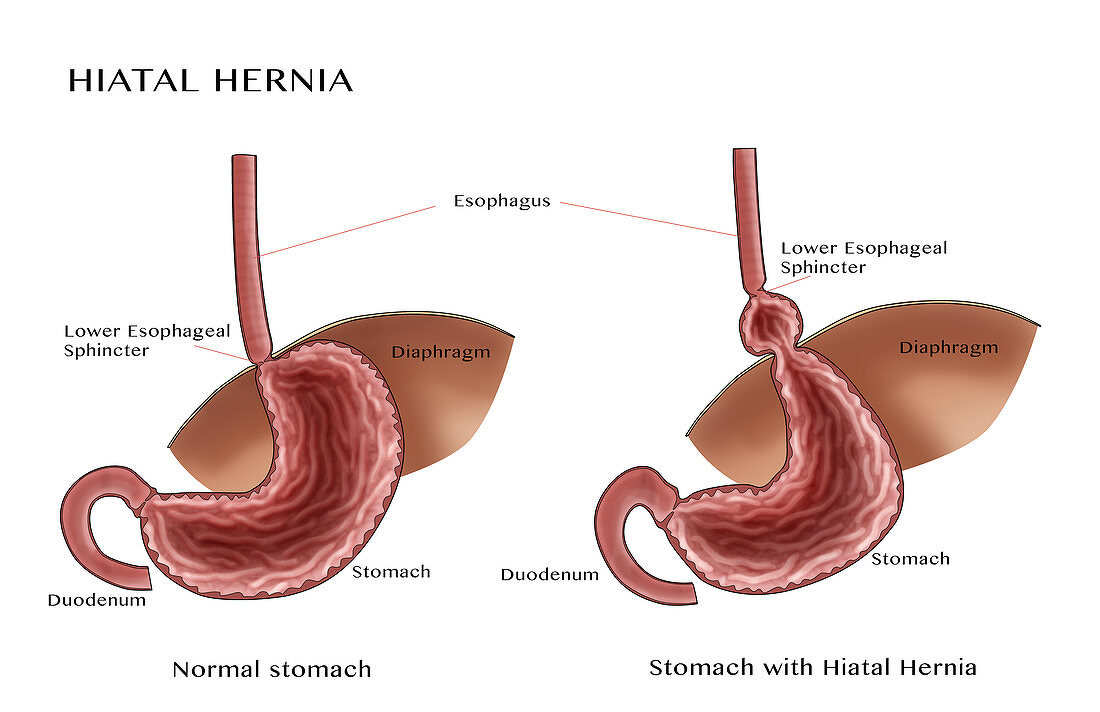 Normal Stomach & Stomach with Hiatal Hernia