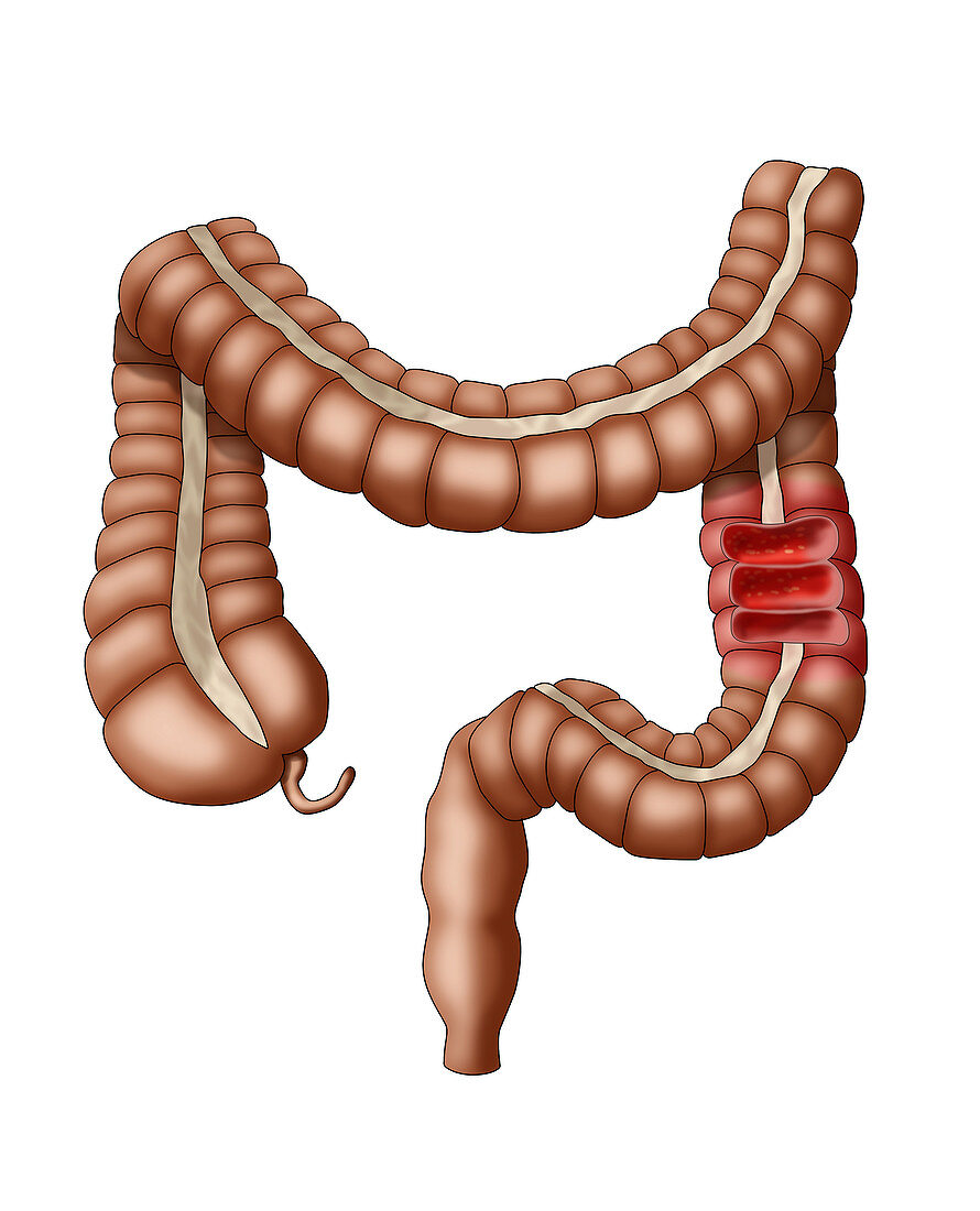 Colitis and the Large Intestine, Illustration