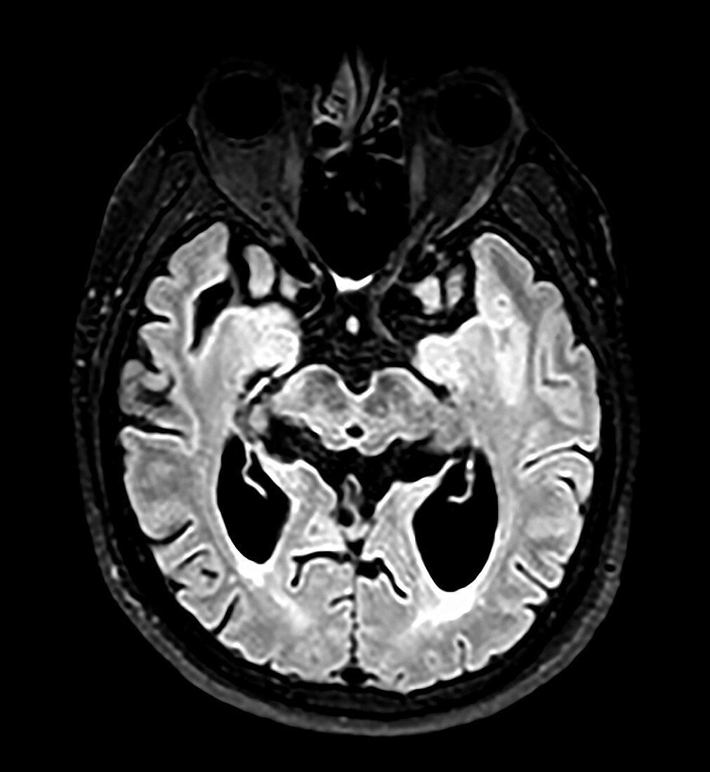 Progressive Supranuclear Palsy (PSP), MRI