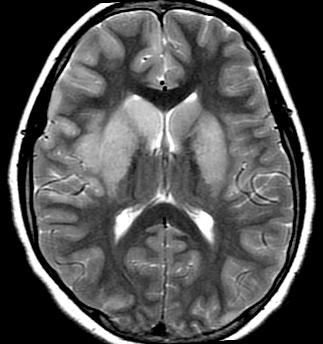Epstein-Barr Encephalitis on MRI