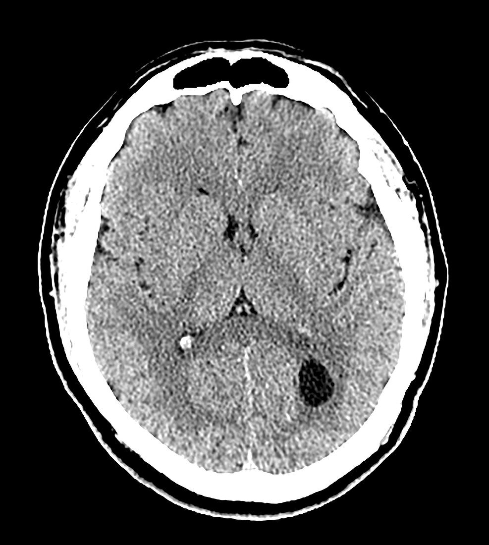Cysticercosis on CT