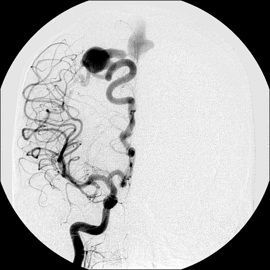Angiogram of AV Fistula
