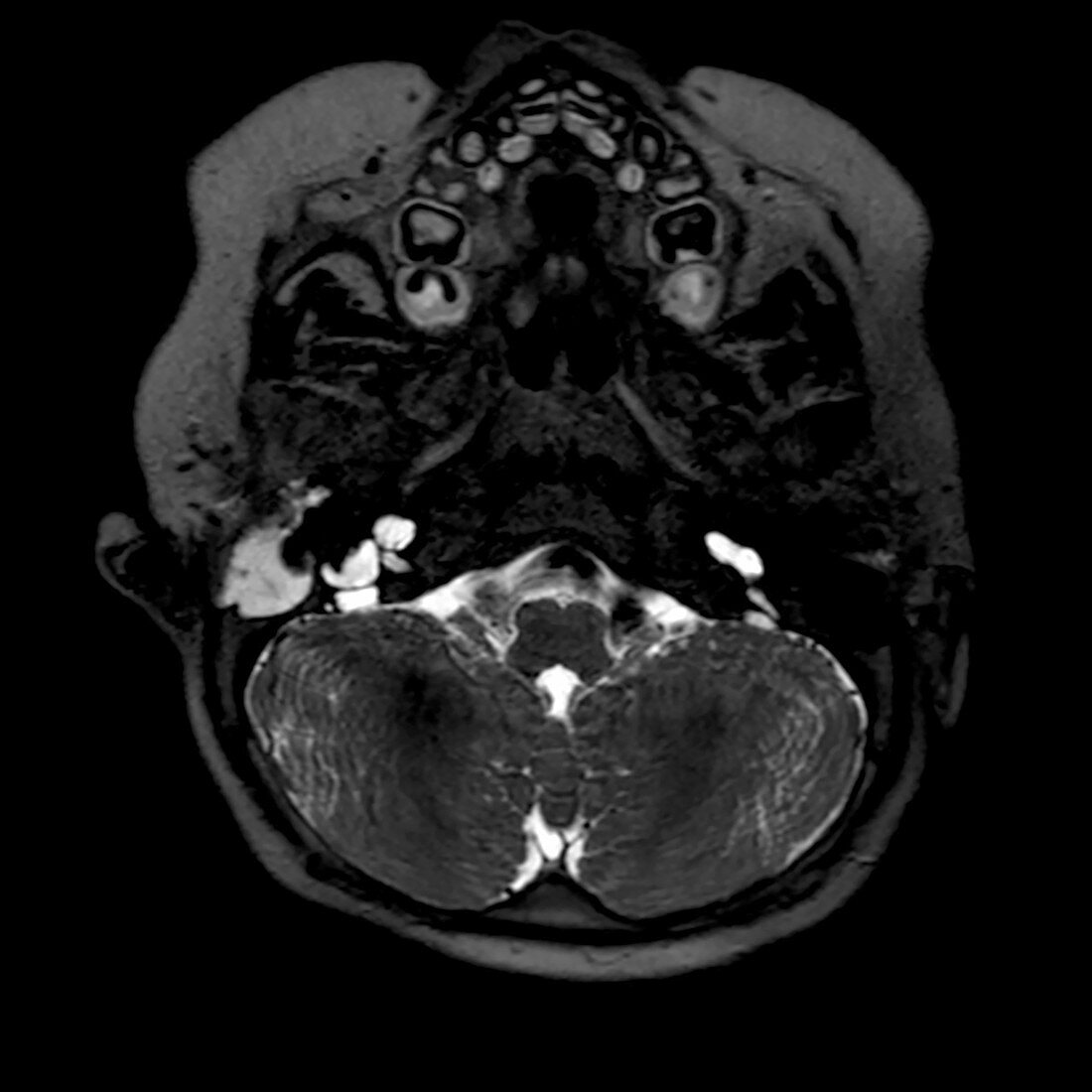 Cystic cochleovestibular anomaly (IP-I), MRI