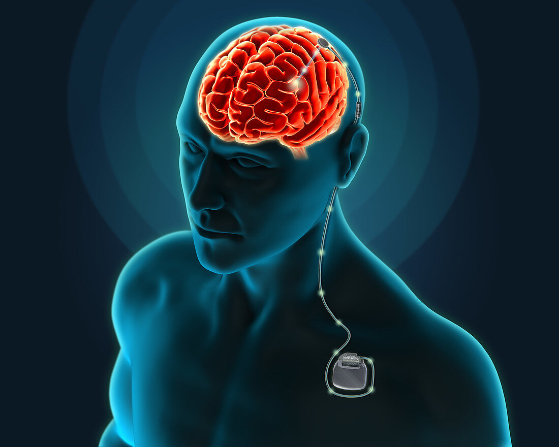 Deep Brain Stimulation, Illustration