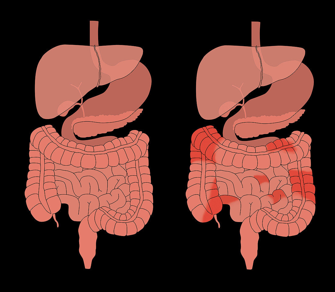 Healthy Digestive System & Crohn's, Comparison