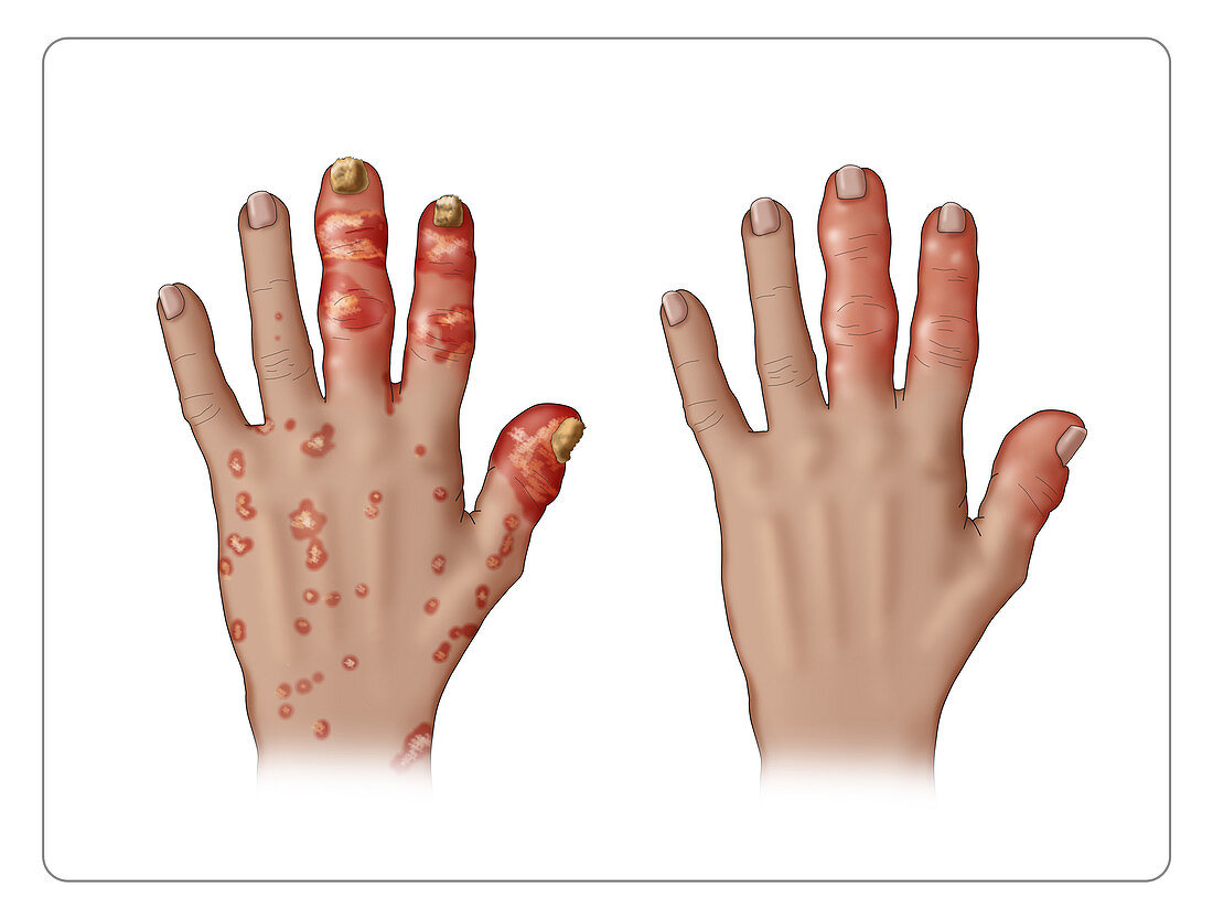 Psoriatic Arthritis with and without Lesions