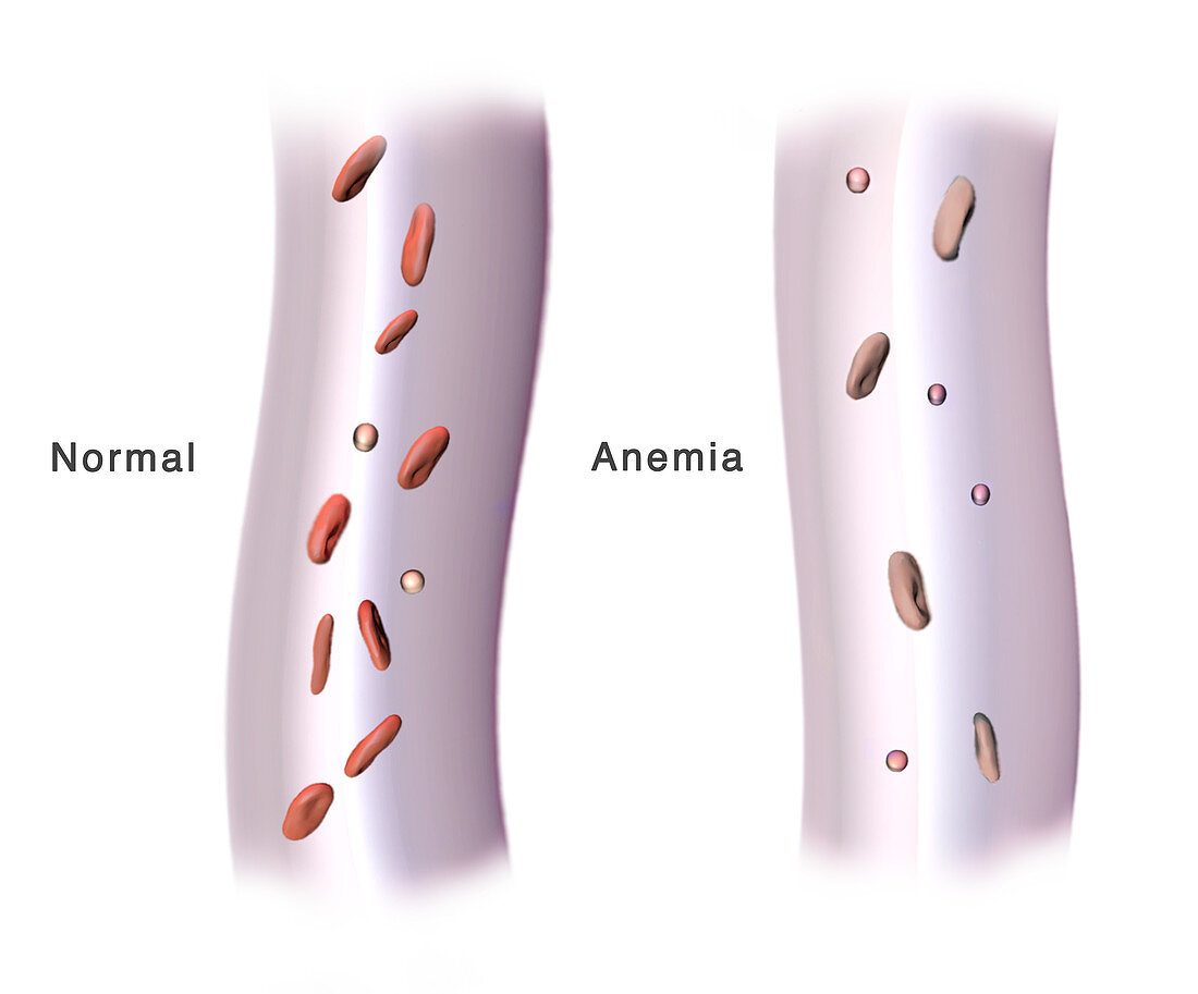 Red Blood Cells and Anaemia, Illustration