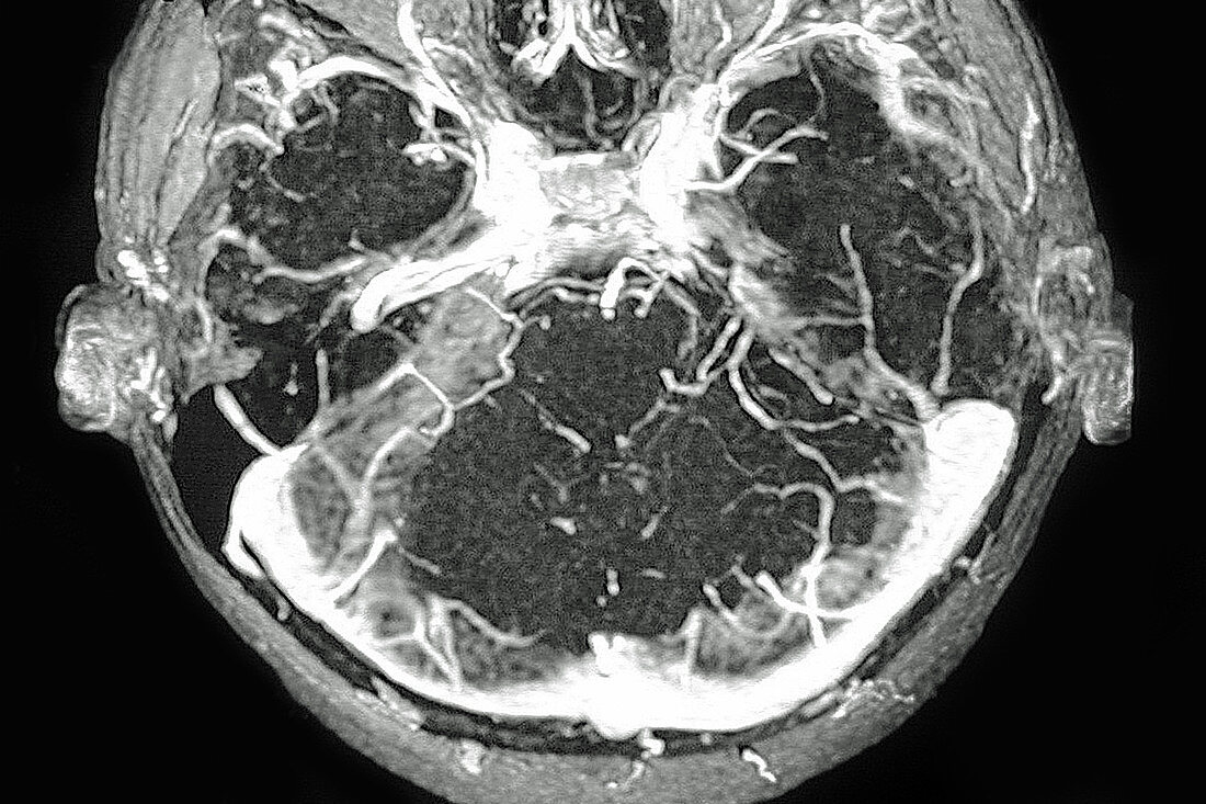 Thrombosis of Venous Sinuses, Dura Mater, MRI