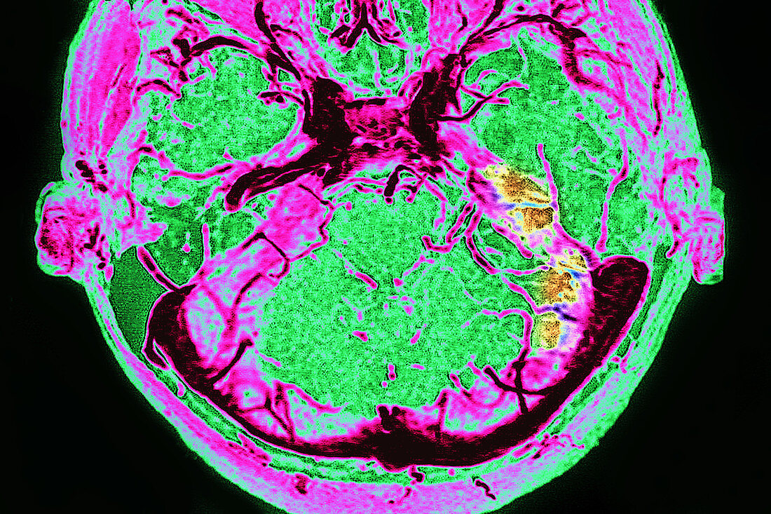 Thrombosis of Venous Sinuses, Dura Mater, MRI