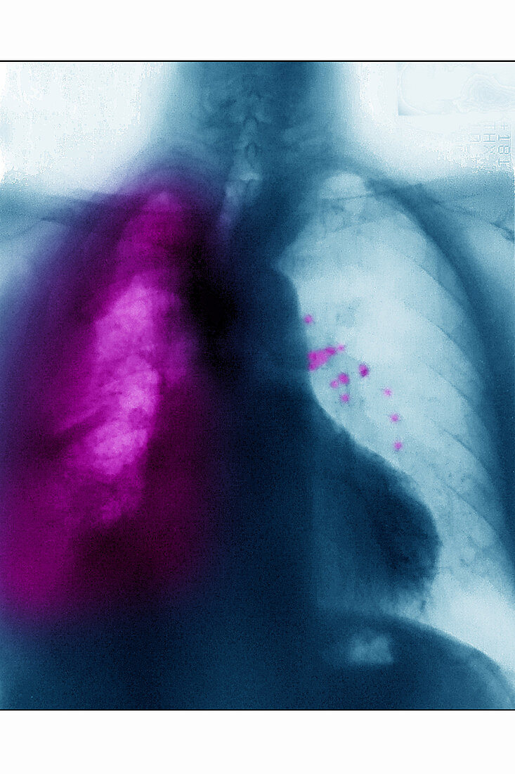 Lung Cancer, X-Ray