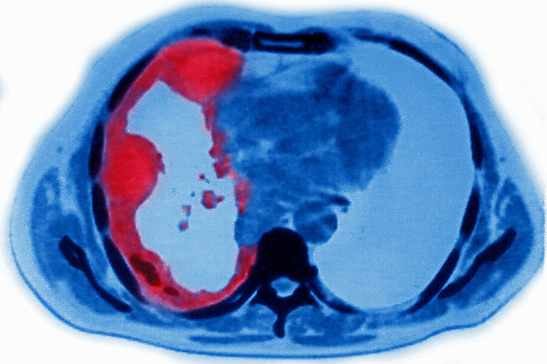 Lung Cancer, CT Scan