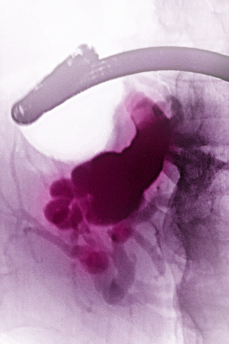Cholelithiasis or Gallstones, X-Ray