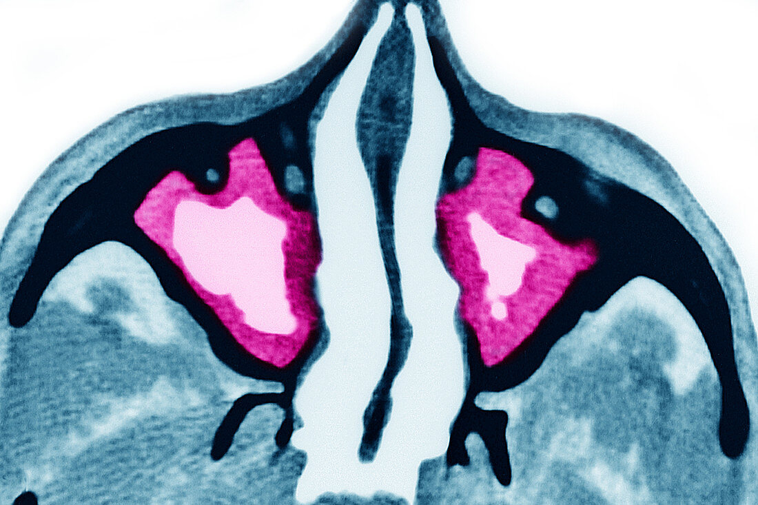 Maxillary Sinusitis, CT Scan