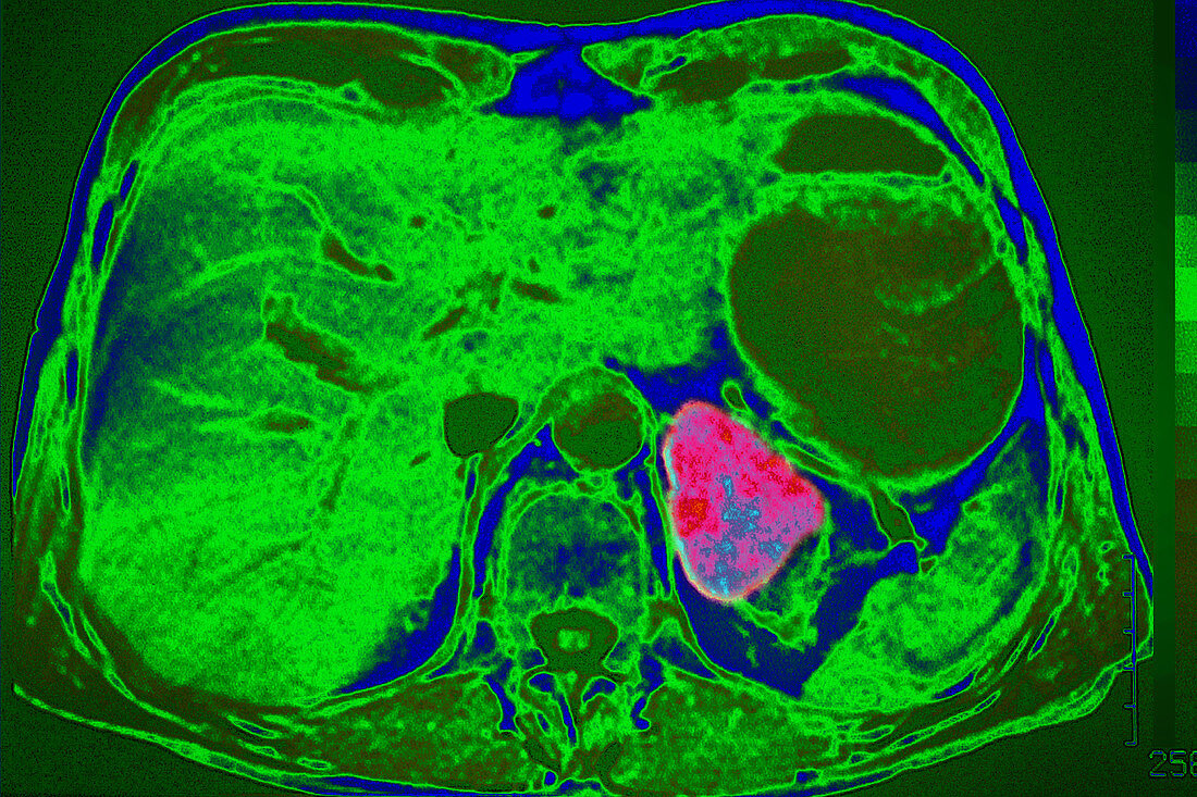 Malignant Adrenocortical Tumour, CT Scan