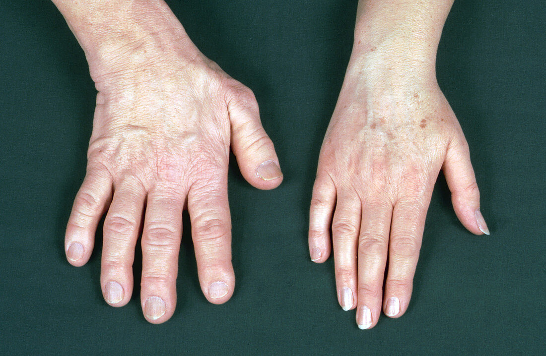 Acromegaly