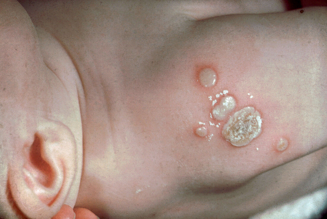 Vaccinia Infection