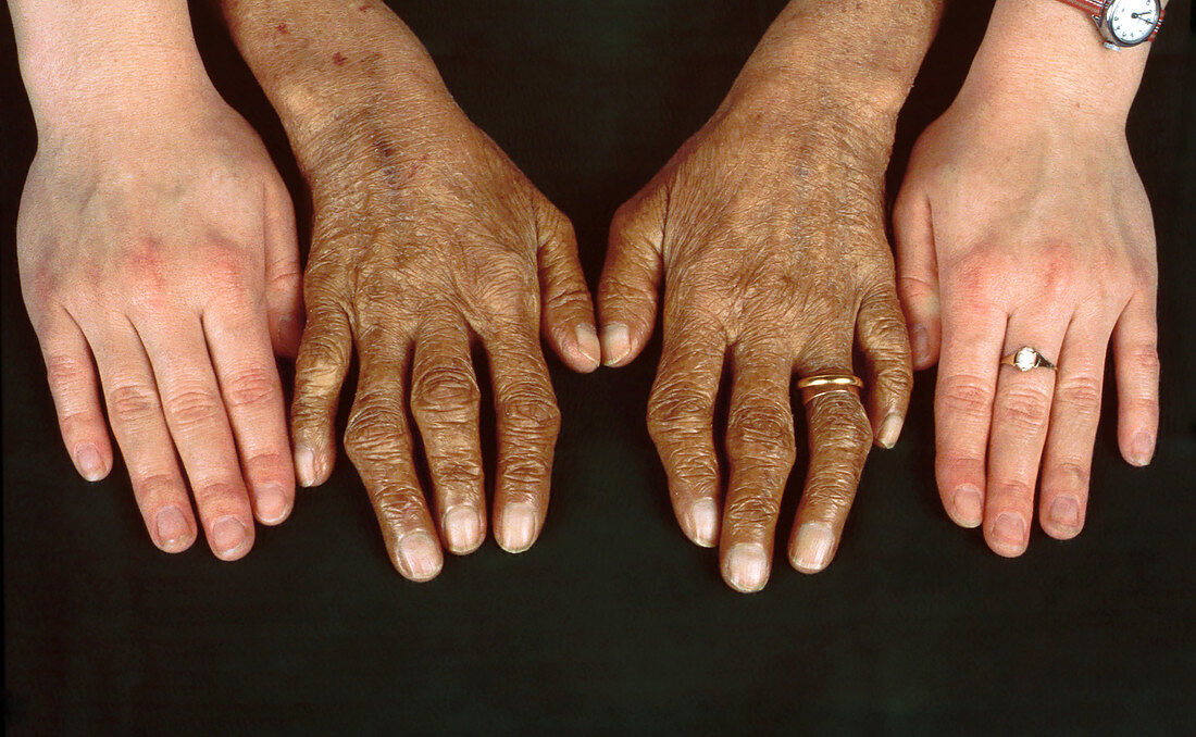 Hemochromatosis, Hand Comparison