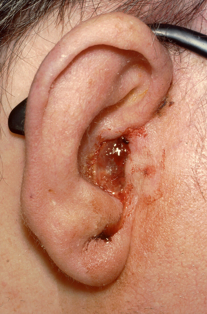 Infected Ear Canal, Atresia