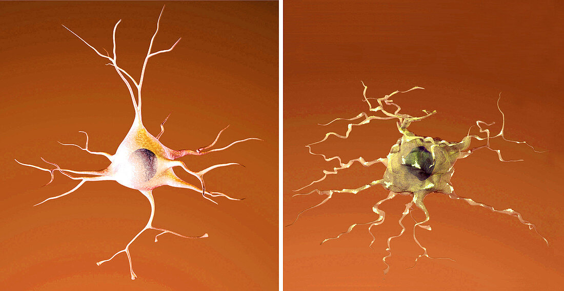 Normal and Dying Neuron, Alzheimer's Disease