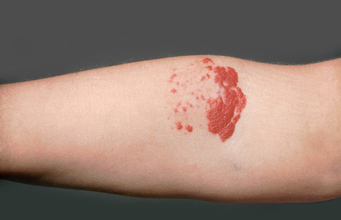 Hemangioma on Arm