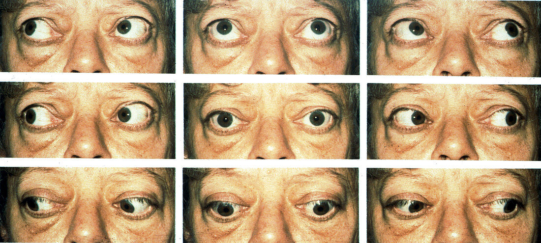 Graves' Ophthalmopathy