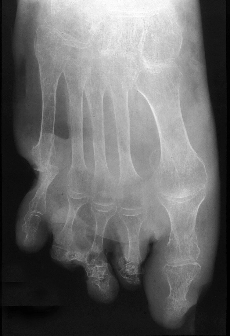 Gangrene from Diabetes, Foot X-Ray