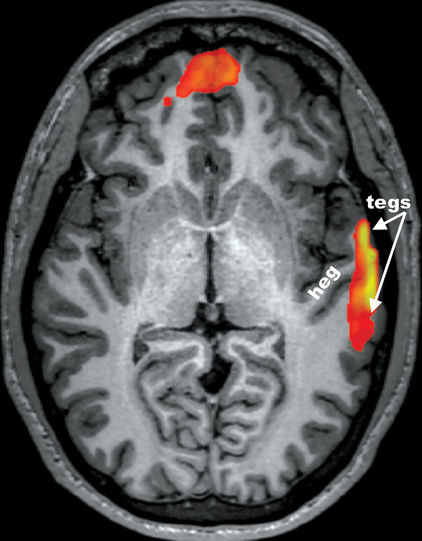 Hearing during Passive Listening, fMRI