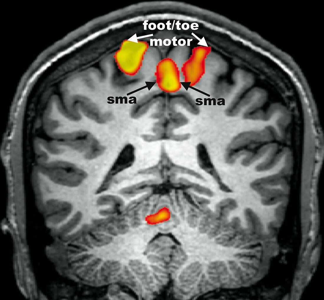Motor Task (feet and toes), fMRI