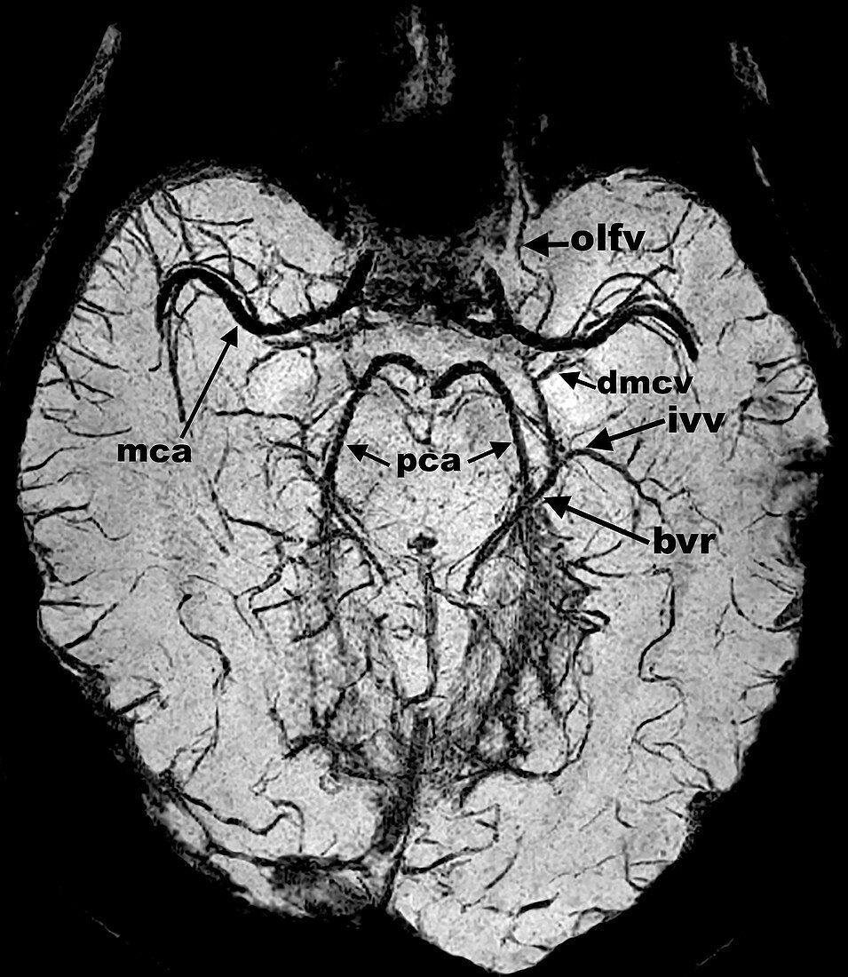 Brain, MRI