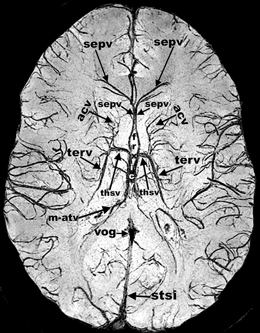 Brain, MRI