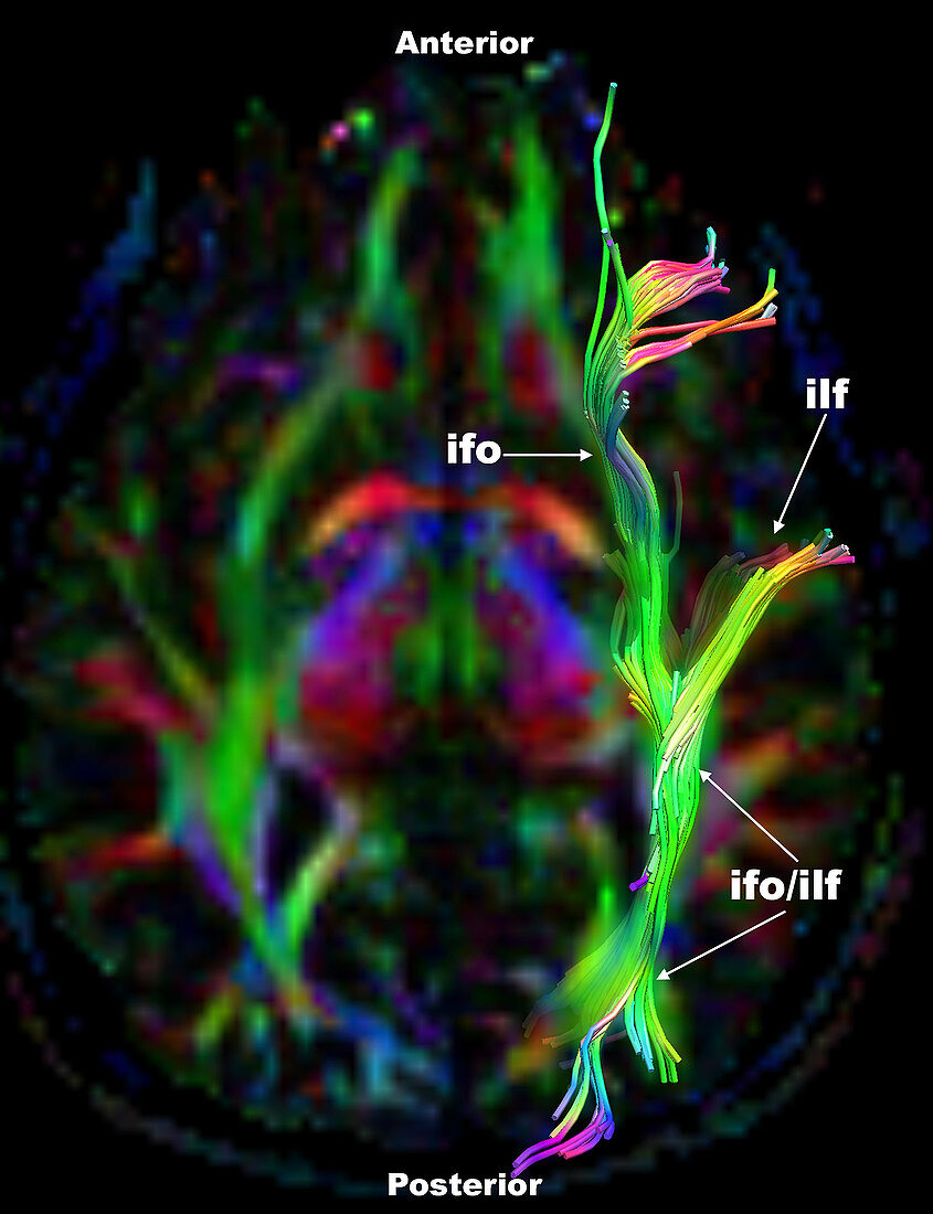 Inferior Frontal-Occipital Fasciculus and ILF, DTI
